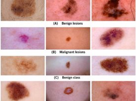 Uncertainty-aware skin cancer classification using entropy-guided multi-phase ensemble learning
