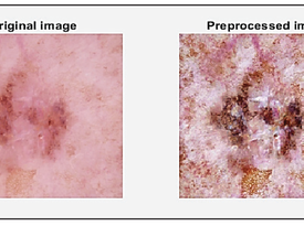 Skin Cancer
